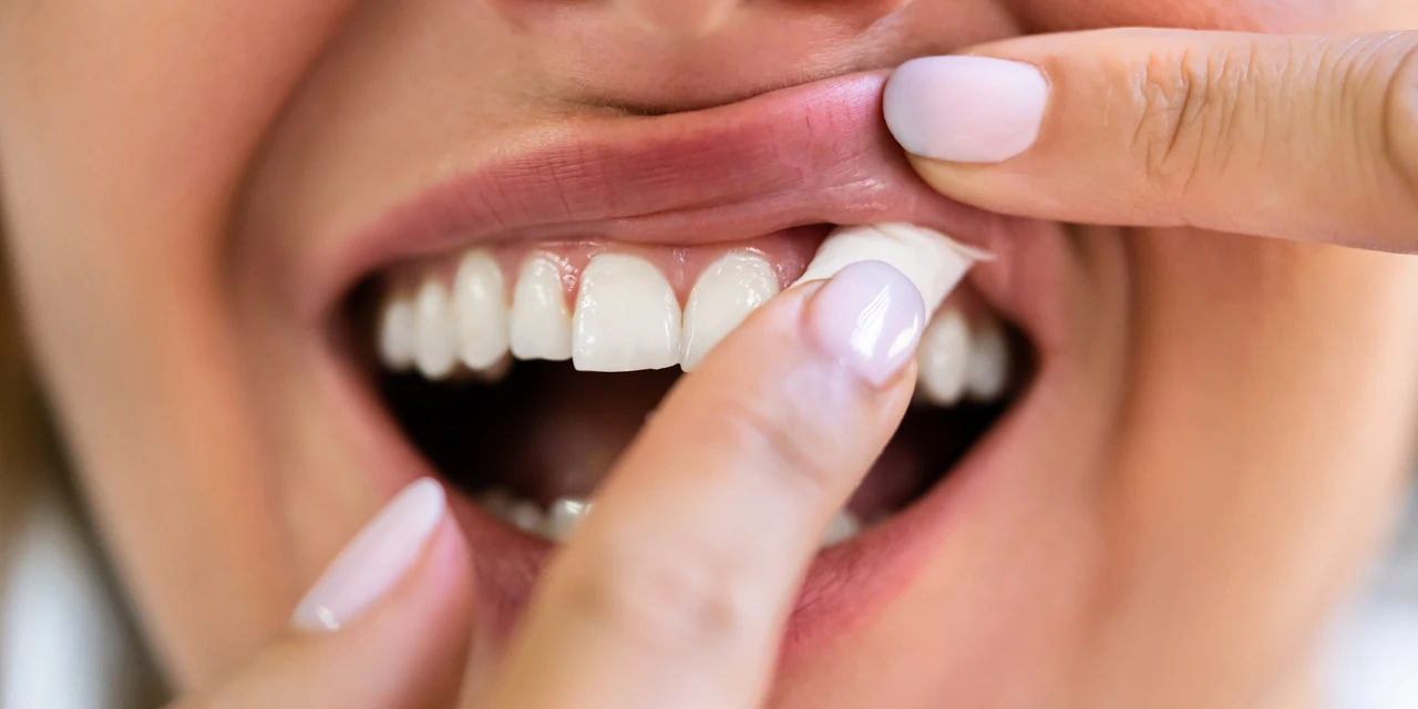 Persoon plaatst snus onder de bovenlip.