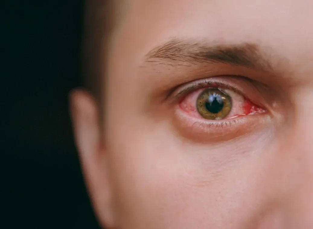 rode-ogen-door-blowen Close up van een gezicht met een rood oog door blowen.